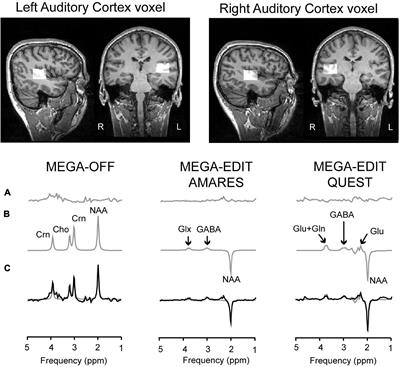 MR-Spectroscopy of GABA and Glutamate/Glutamine Concentrations in Auditory Cortex in Clinical High-Risk for Psychosis Individuals